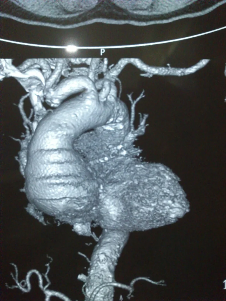 Conditions Treated with Cardiovascular Surgery