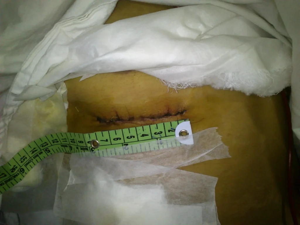 Advantages of Cardiovascular Surgery