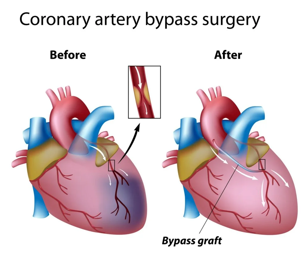 Coronary Artery Bypass Surgery​