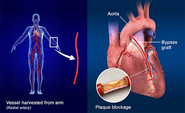 Recovery After Total Arterial CABG